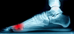 Treatment Options for Sesamoiditis