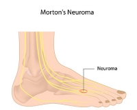 Morton’s Neuroma Surgery