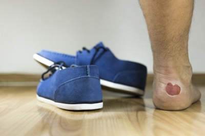 Defining Foot Blisters and Their Origins