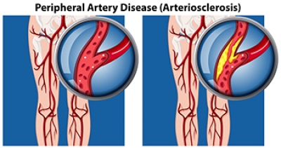 Signs of Peripheral Artery Disease