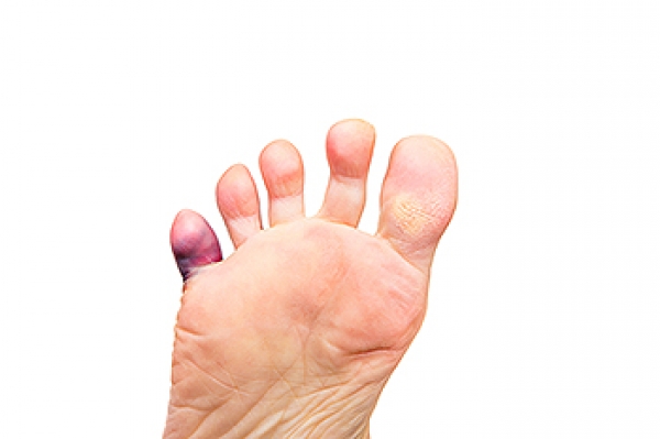 Pinky Toe Hurts in Shoes: Causes, Solutions & Best Footwear Recommendations