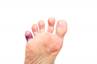 Causes of Pinky Toe Pain
