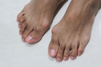 Definition and Causes of a Bunion